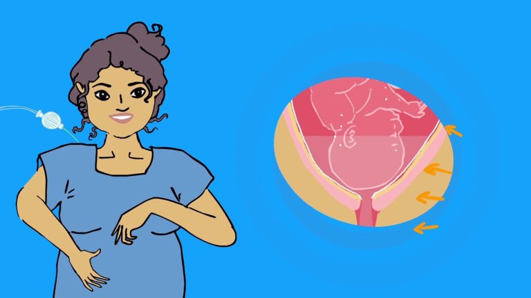péridurale accouchement femme enceinte bébé