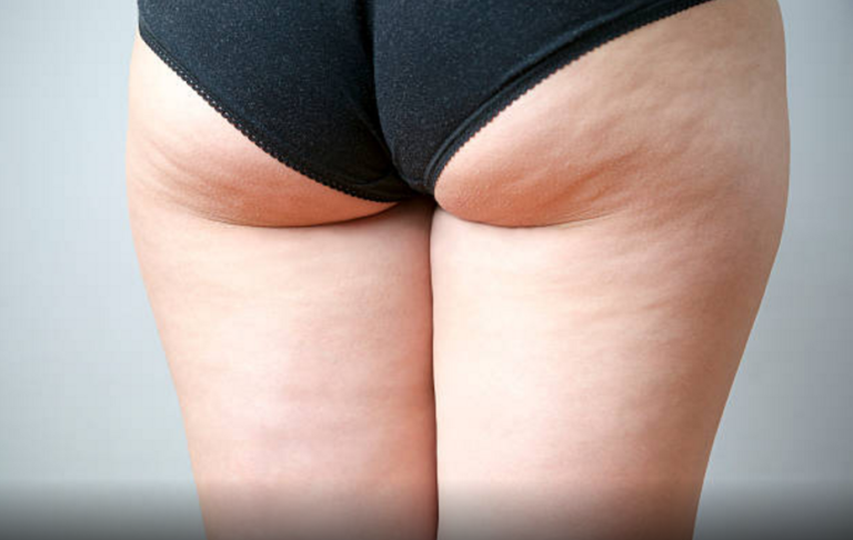 pourquoi on a de la cellulite aliments à éviter