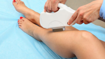 épiler laser techniques épilation poils