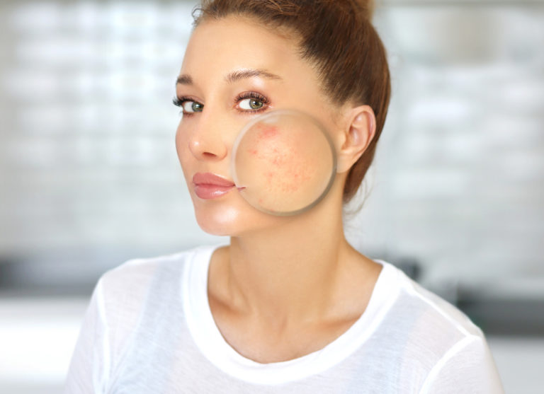 acné boutons femme visage peau type nature astuce épiderme