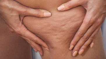 peau d'orange faire disparaitre la cellulite