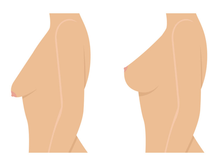 femme poitrine seins qui tombent remonter