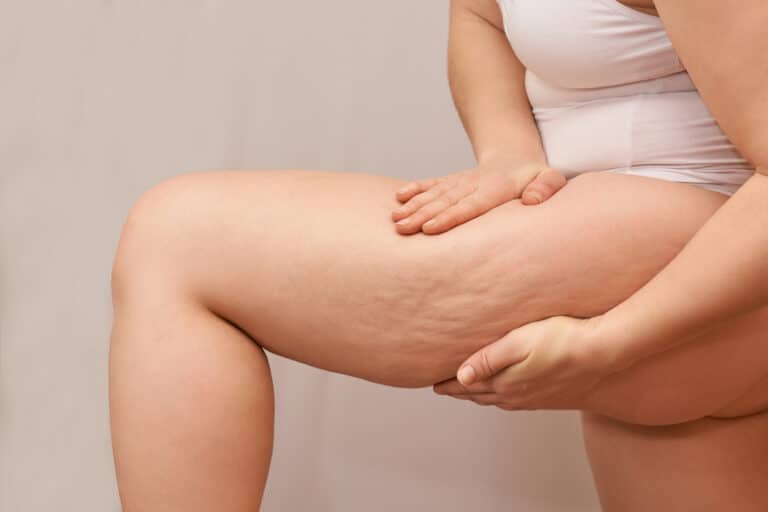 éliminer cellulite peau orange femme jambes capitons cuisse corps