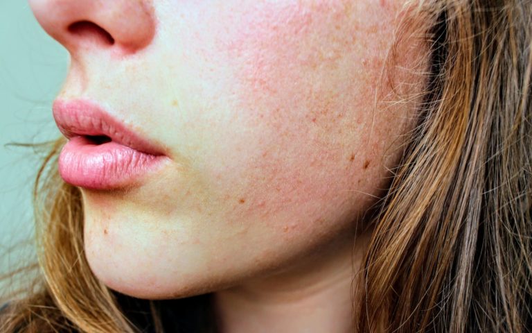 petites rougeurs lèvres bouche french kiss
