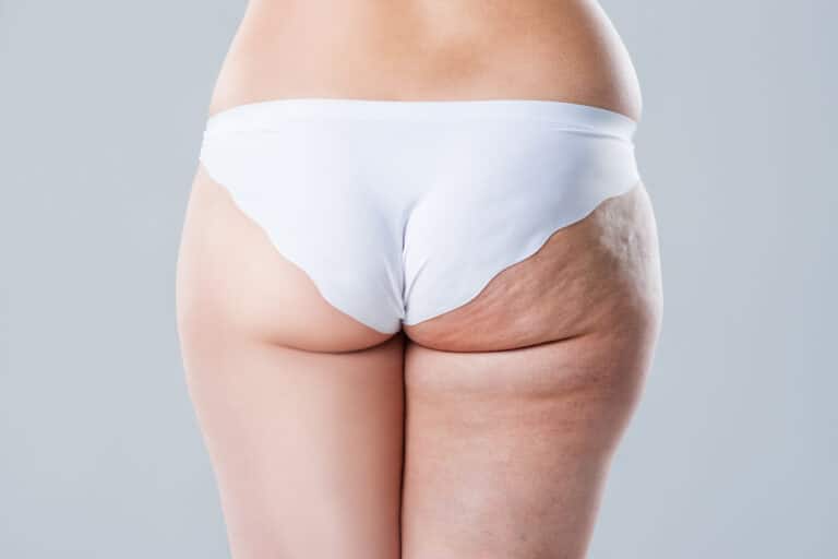 avant après cuisses cellulite jambes femme peau orange culotte cheval capitons