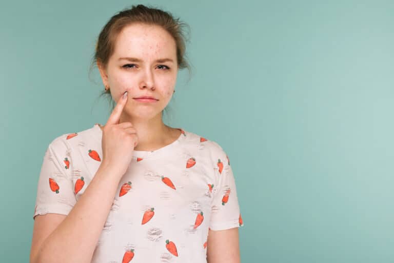 femme boutons acné peau à problèmes imperfections