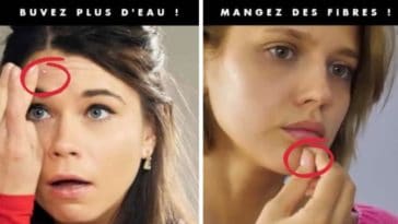 acné du visage remèdes solutions
