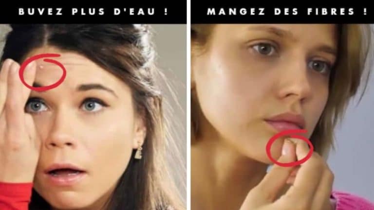 acné du visage remèdes solutions