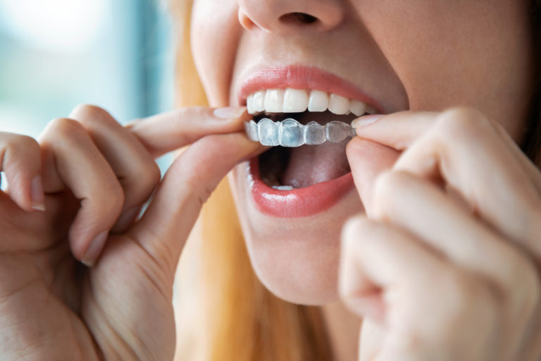 femme gouttière invisible aligner dents appareil dentaire
