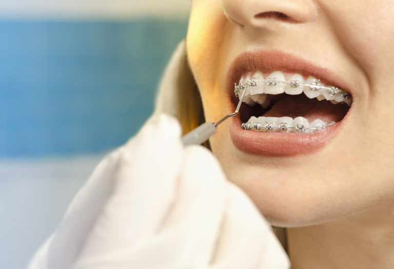 sois dents orthodontie bagues sourire bouche femme