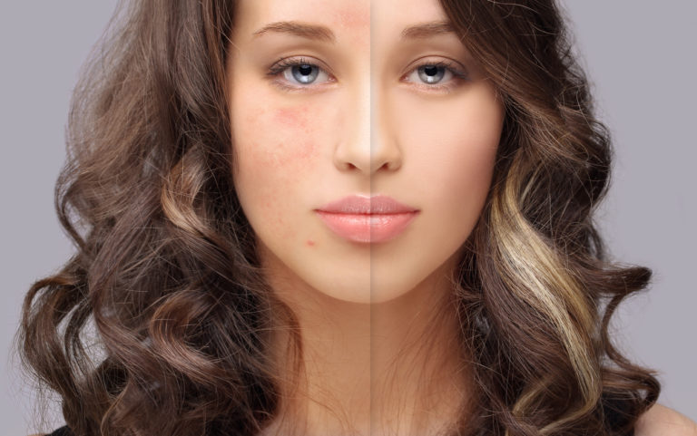 acné boutons peau avant après femme mixte grasse traiter