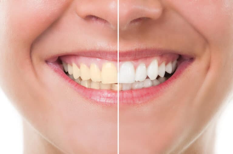 dents blanches sourire femme