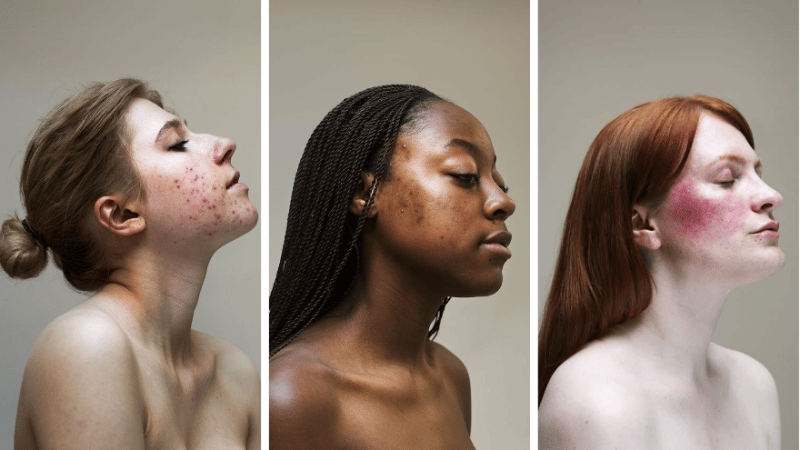 femmes peau acnéique Sophie Harris Taylor photos