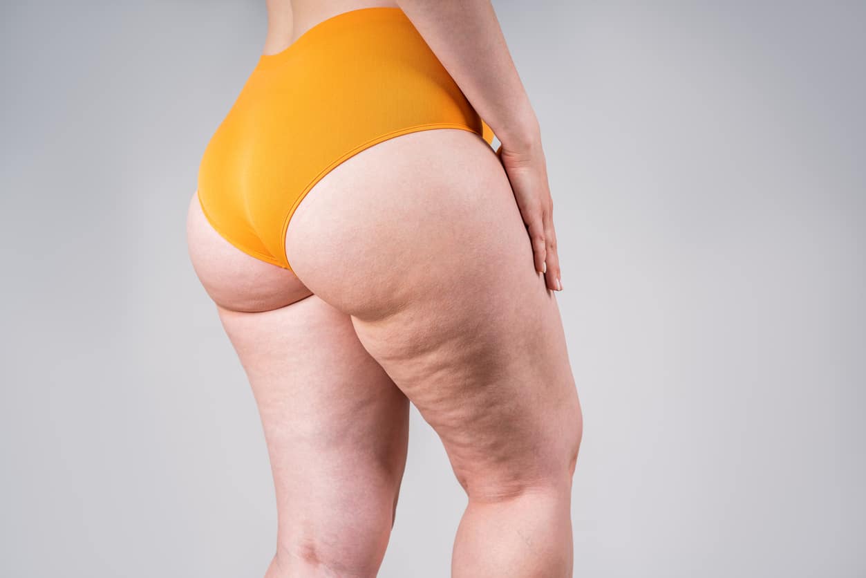 cellulite bienfaits femme jambes cuisses corps peau orange